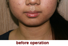 plastic-surgery-chin-augmentation